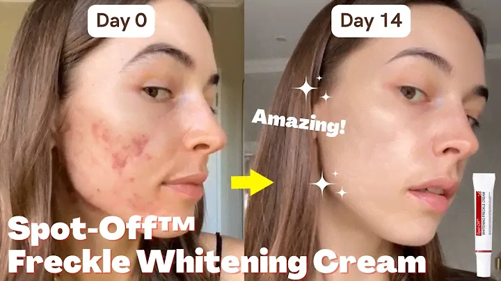 Spot-Off Freckle Whitening & Removal Cream | Dayiala.com
